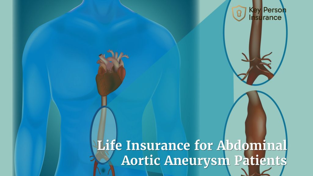 Life Insurance for Abdominal Aortic Aneurysm Patients by Key Person Insurance